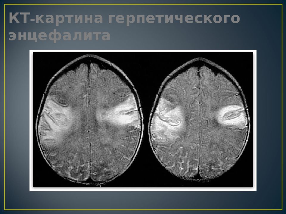 Энцефалит мрт картина