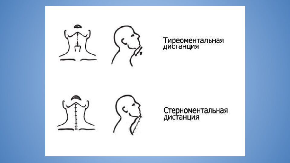 Трудные дыхательные пути в анестезиологической практике. Difficult Airway