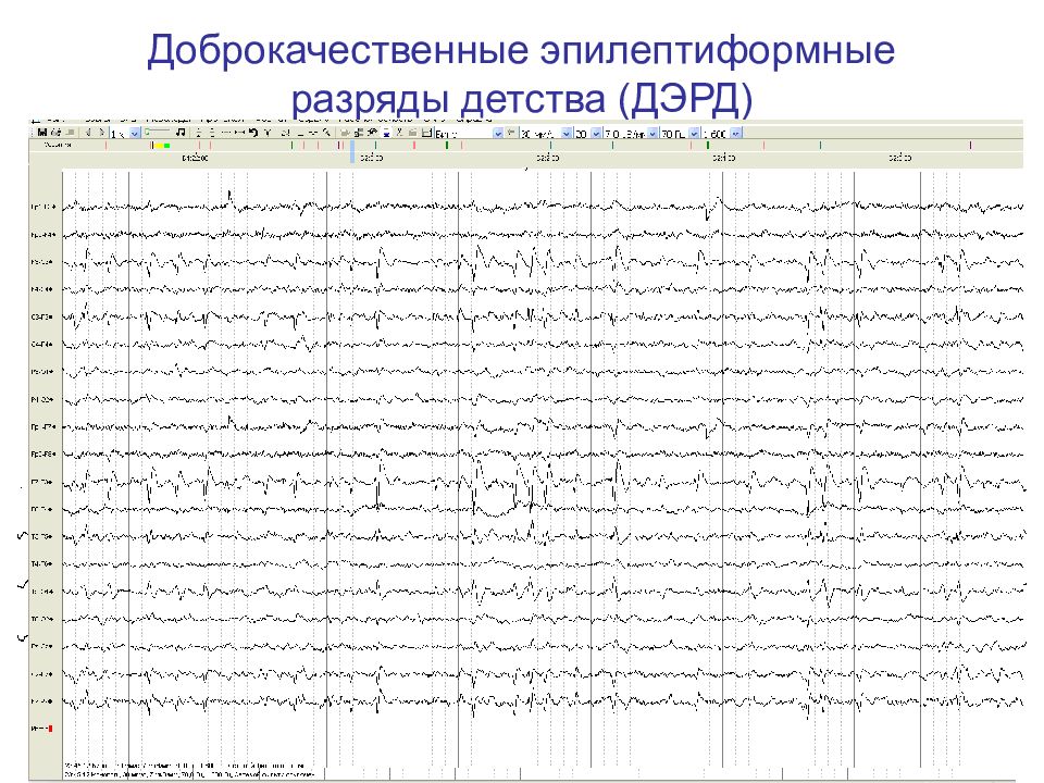 Региональная эпилептиформная активность. Эпиактивность на ЭЭГ. Диффузная эпиактивность. ЭЭГ С эпиактивностью у ребенка. Доброкачественная эпиактивность у детей на ЭЭГ.