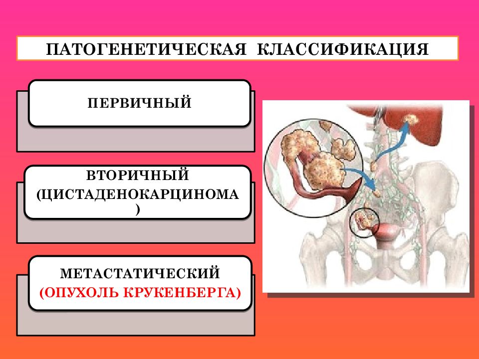 Презентация на тему рак яичников