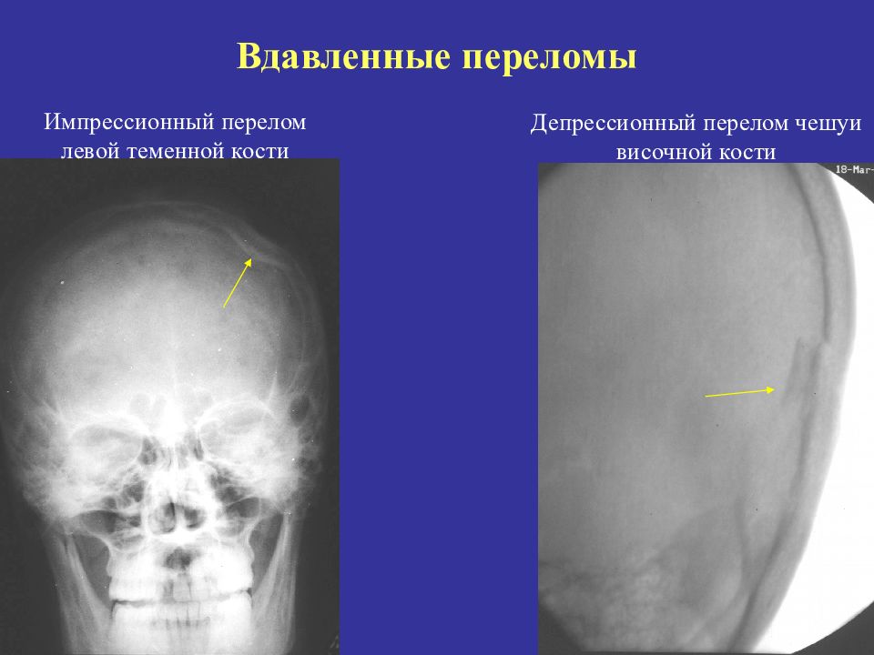 Перелом теменной кости у грудного. Вдавленный перелом костей черепа рентген. Вдавленный импрессионный перелом лобной кости. Импрессионный перелом свода черепа. Вдавленный перелом теменной кости кт.