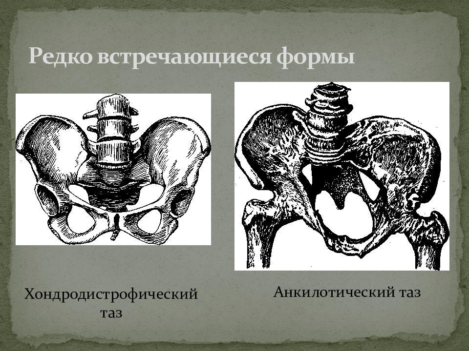 Презентация аномалии костного таза