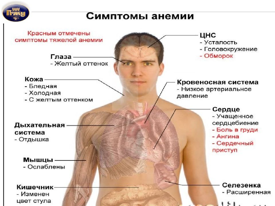 Диагностика анемии картинки