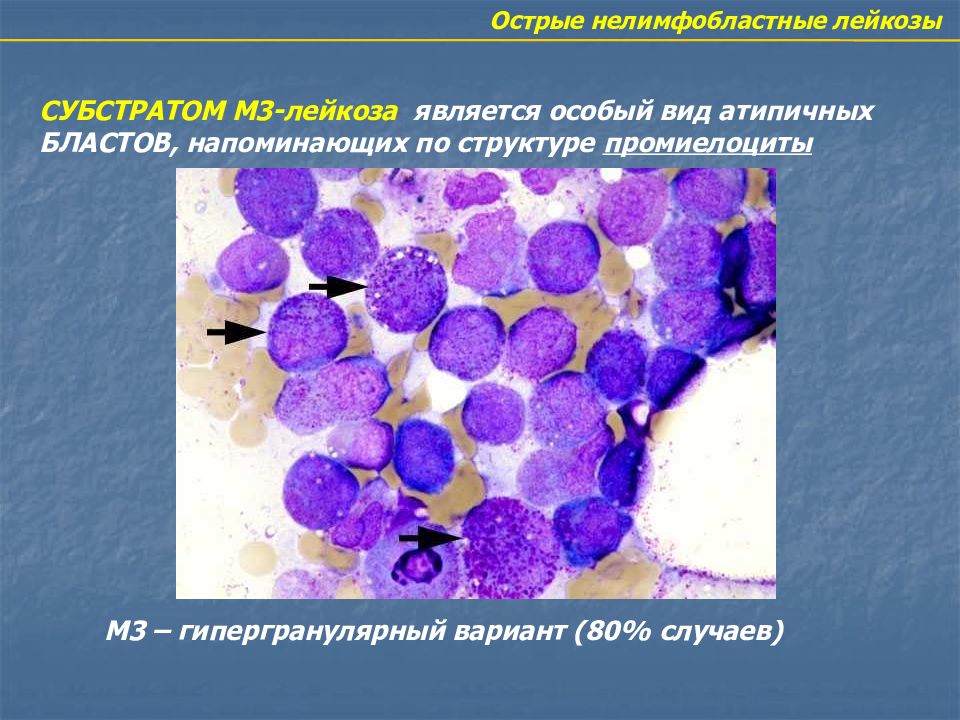 Острый лимфолейкоз презентация