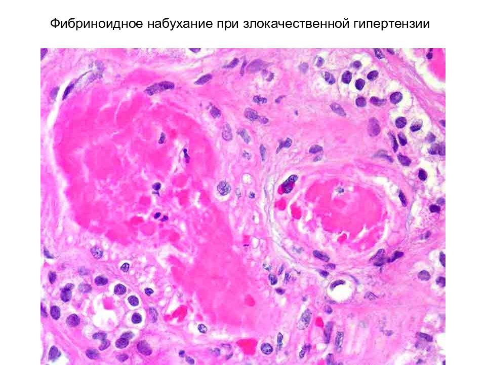 Фибриноидное набухание это. Фибриноидное набухание патанатомия. Фибриноидное набухание клапана сердца патологическая анатомия. Патологическая анатомия мукоидное набухание фибриноидное. Фибриноидный некроз гистология.