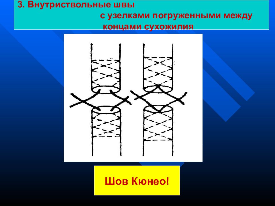 Презентация операции на сухожилиях