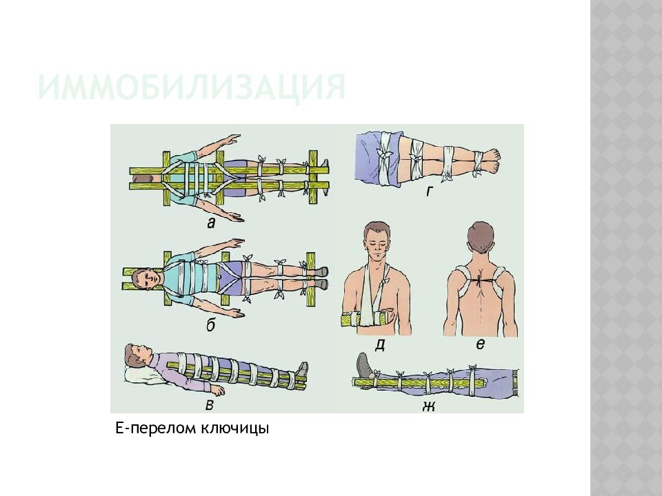 Оказание первой помощи при переломе ключицы. Иммобилизация при переломе позвоночника. Иммобилизационные средства при переломе позвоночника. Иммобилизация конечности при переломе позвоночника. Иммобилизация подручными средствами.