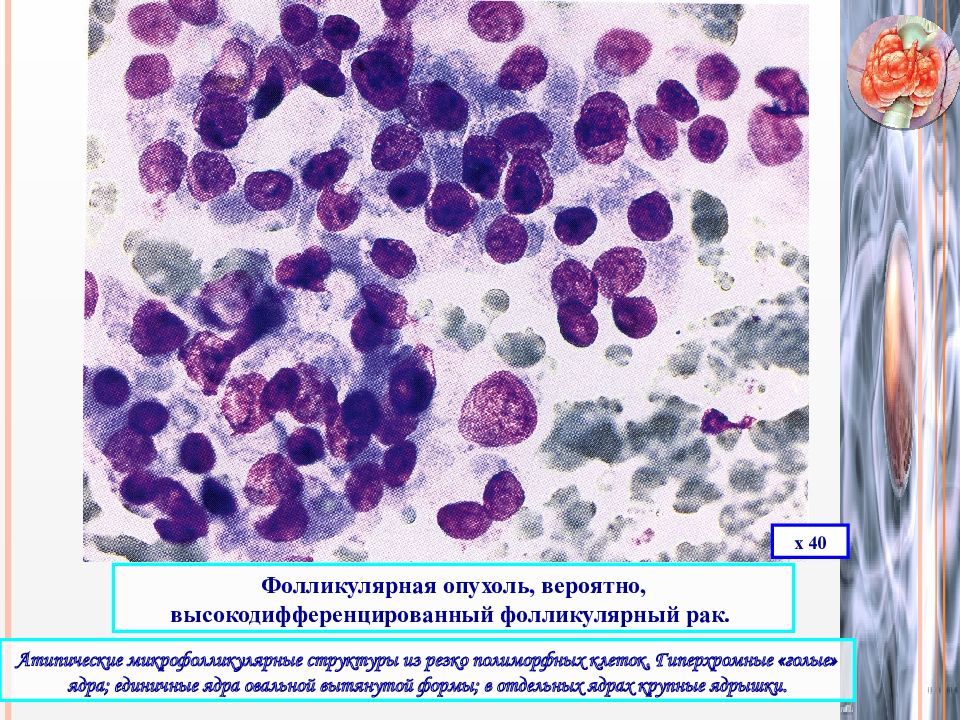 Клетки с гиперхромными ядрами. Фолликулярная аденома цитология. Аденома щитовидной железы цитология. Папиллярная аденома щитовидной железы. Фолликулярная аденома щитовидной железы цитология.