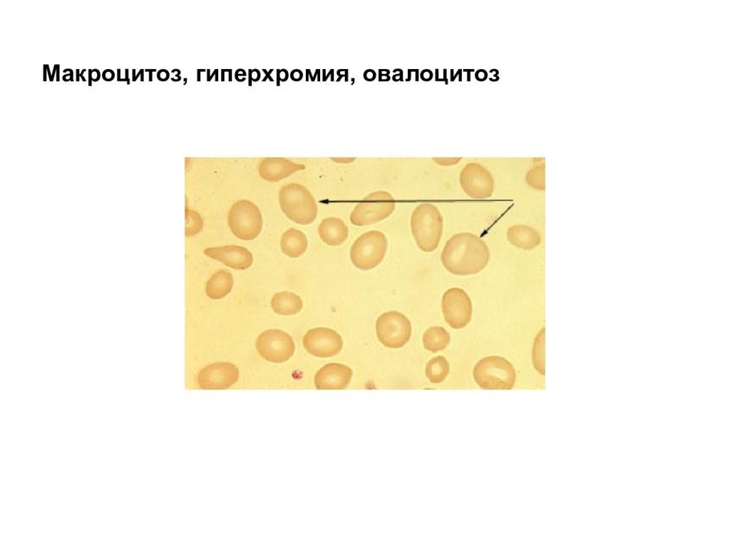 Эллиптоцитоз. Макроцитоз гиперхромия анемия. Наследственный овалоцитоз.