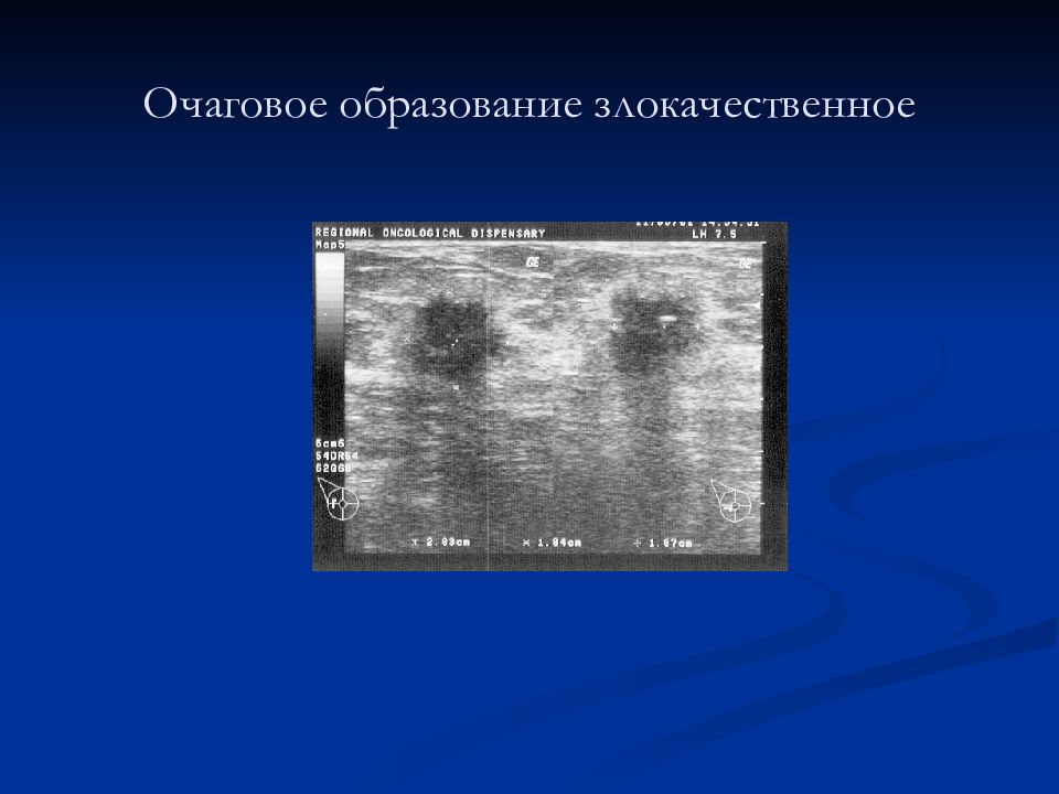 Лучевая диагностика заболеваний молочных желез. Рентгенодиагностика заболеваний молочных желез. Очаговые образования молочных желез. Очаговое образование молочной железы что это такое. Очаговое образование молочной железы УЗИ.