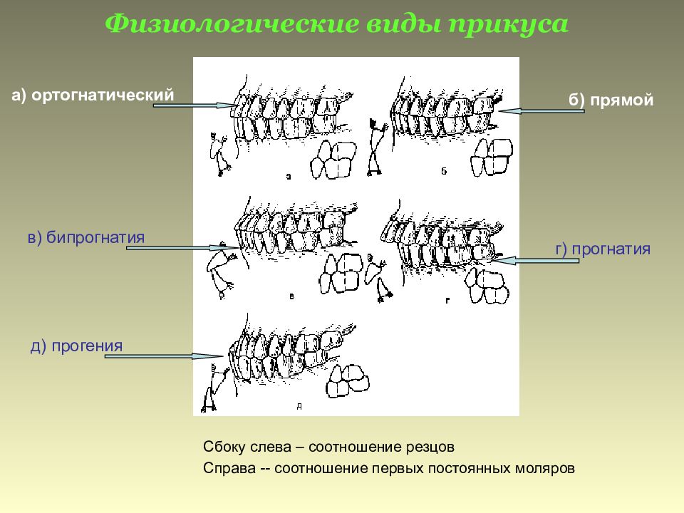 Виды прикуса. Виды физиологического прикуса. Прикус физиологический и патологический. Физиологический ортогнатический прикус. Физиологические и патологические виды прикуса.