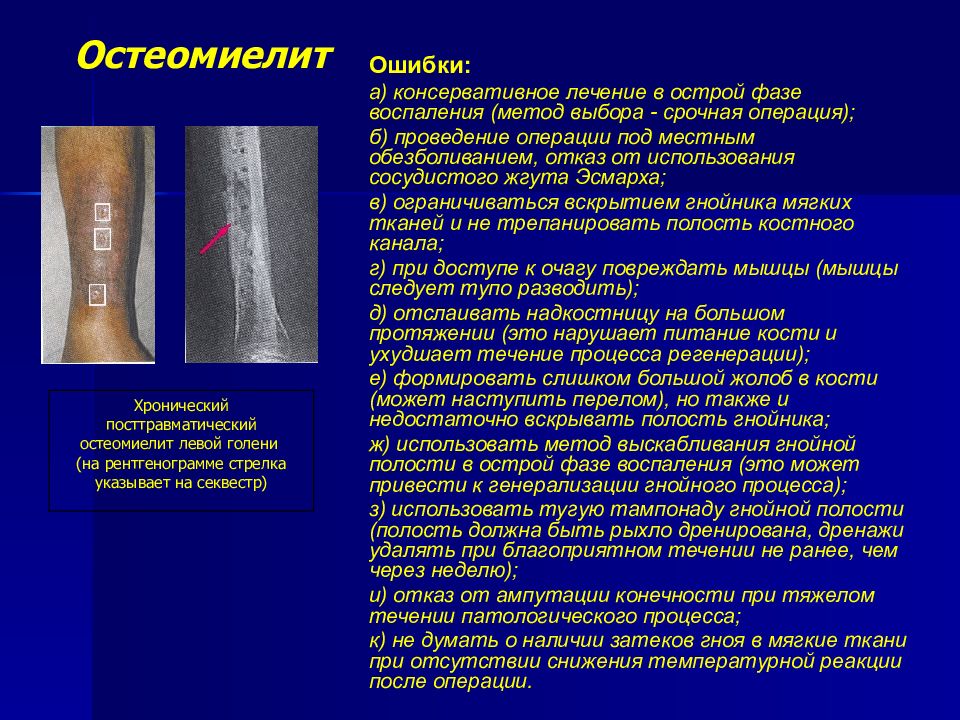 Презентация по хирургии остеомиелит