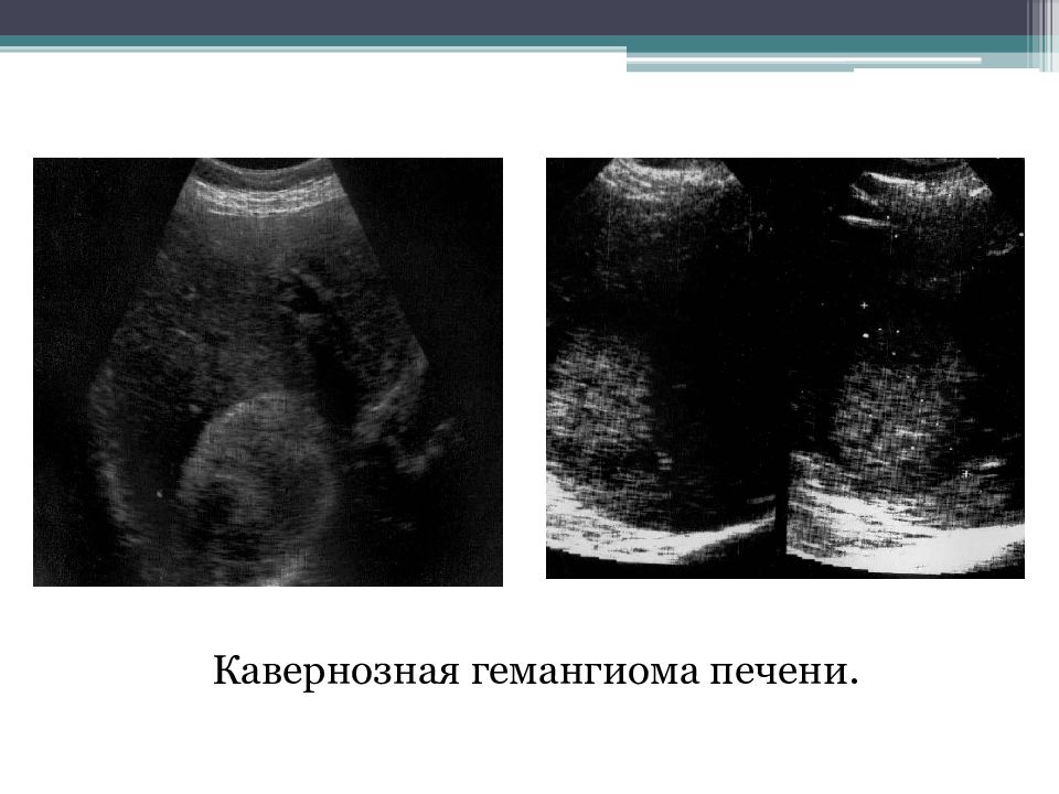 Эхографическую картину кавернозной гемангиомы печени необходимо дифференцировать с