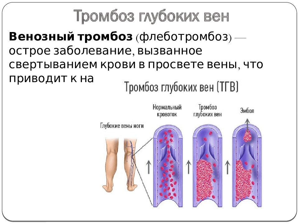 Типы тромбозов. Виды тромбов. Классификация тромбов по виду сосуда.