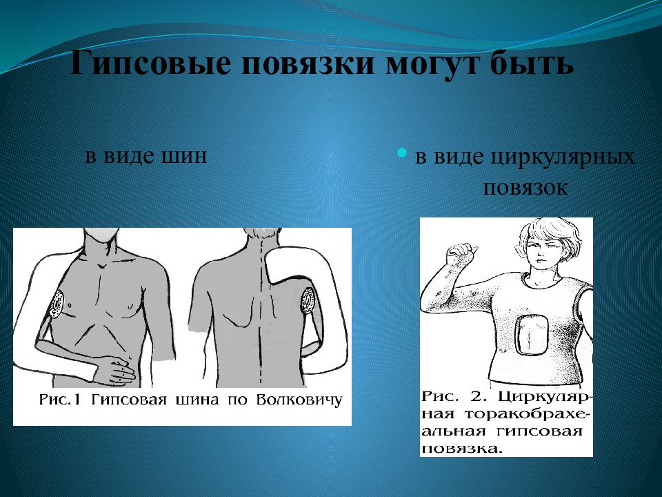 Гипсовые повязки шины. Повязка по Волковичу. Гипсовая повязка по Волковичу. Гипсовая лонгета при переломе плеча. Гипсовая шина Волковича.