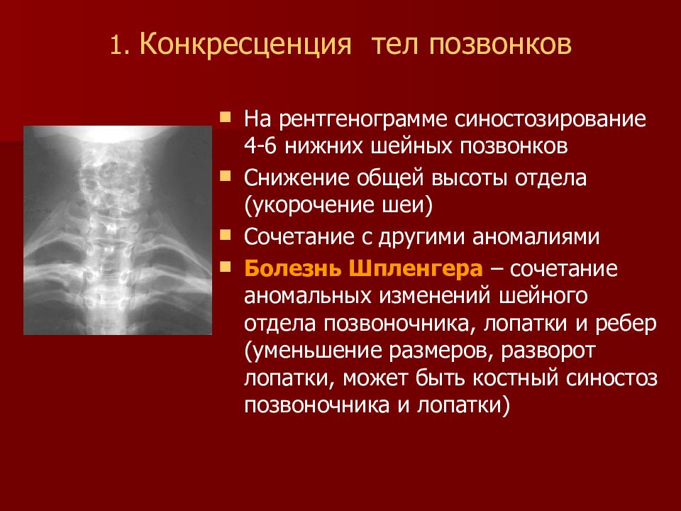 Конкресценция позвонков. Конкресценция шейных позвонков с4-с5. Неполное сращение тел позвонков. Сращение тел позвонков кт. Неполная конкресценция шейных позвонков.