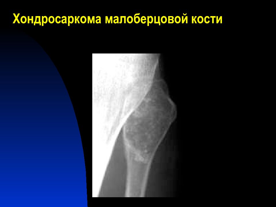 Хондросаркома. Хондросаркома малоберцовой кости. Хондросаркома плечевого сустава. Хондросаркома рентгенодиагностика. Хондросаркома рентген признаки.