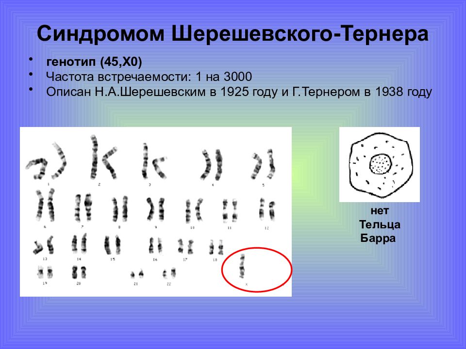 Синдром клайнфельтера шерешевского тернера. Тельца Барра в кариотипе. Генотип Шерешевского Тернера. Синдром Шерешевского Тернера тельце Барра.