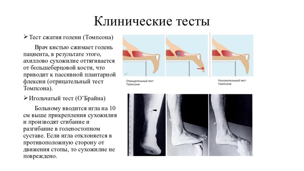 Клинические тесты. Тест Томпсона на ахиллово сухожилие. Симптом Томпсона ахиллова сухожилия. Симптомы повреждения ахиллова сухожилия. Диагноз разрыв ахиллова сухожилия.