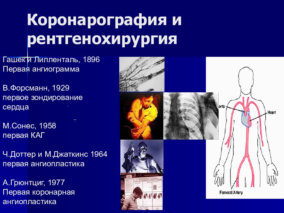 Коронарография. Коронарография сердца. Проведение коронарографии сердца.