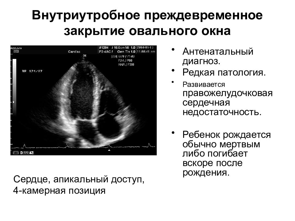 Овальное окно. Незаращение овального окна. Незаращение овального отверстия сердца. Закрытие овального окна. Преждевременное закрытие овального окна.