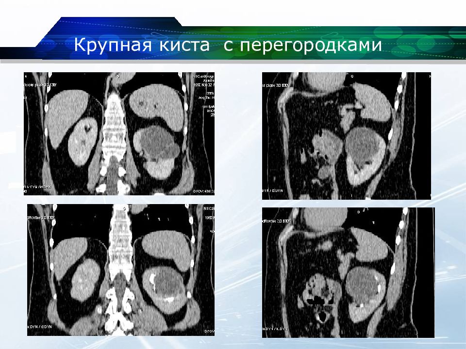 Типы кисты почек. Парапельвикальная киста на кт. Гиперденсная киста почки кт. Многокамерная киста почки на кт. Bosniak классификация кист почек кт.