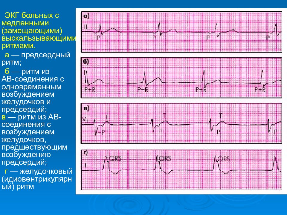 Ритм на экг. Ритм АВ соединения на ЭКГ. Ритм АВ-соединения с предшествующим возбуждением предсердий. Замещающий ритм из АВ соединения на ЭКГ. Ритм av соединения на ЭКГ.