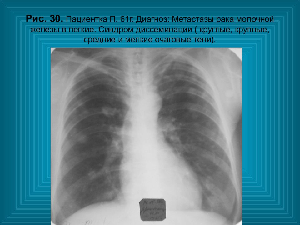 Метастазы в легких рентгенологическая картина