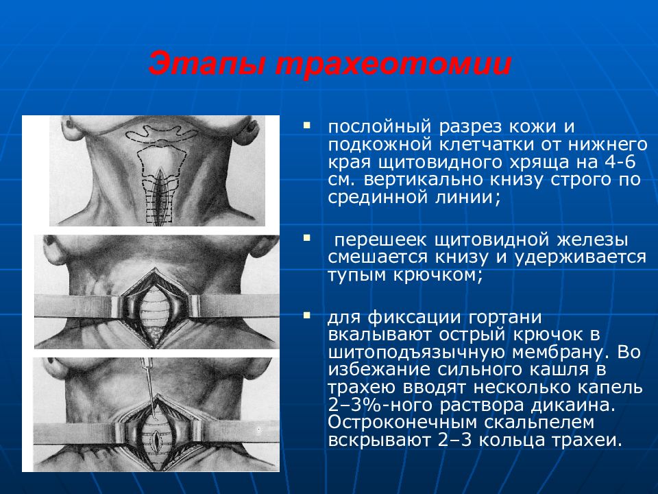 Трахеостомия техника выполнения в картинках