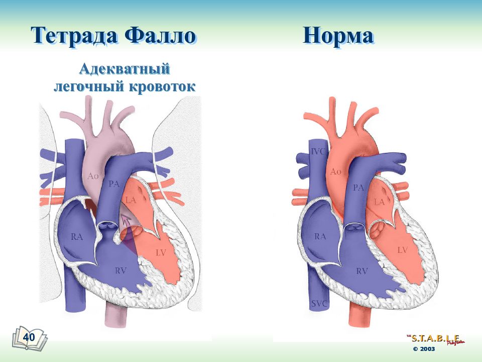 Тетрада фалло у детей