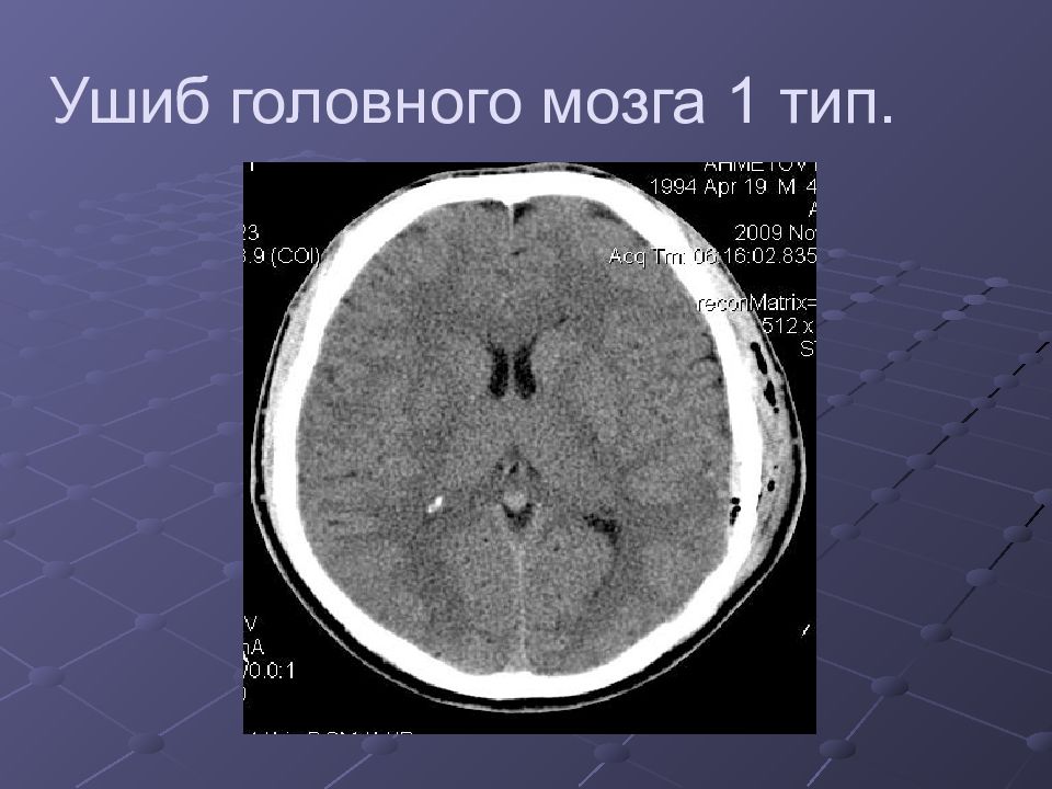 Презентация ушиб головного мозга