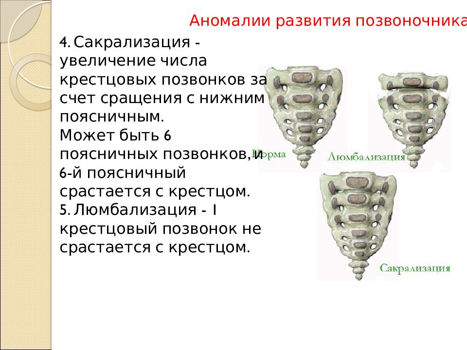 Сросшиеся крестец. Люмбализация s1 позвонка классификация. Сакрализация l5 люмбализация s1. Люмбализация s1 позвонка мрт. Переходный позвонок люмбализация s1.