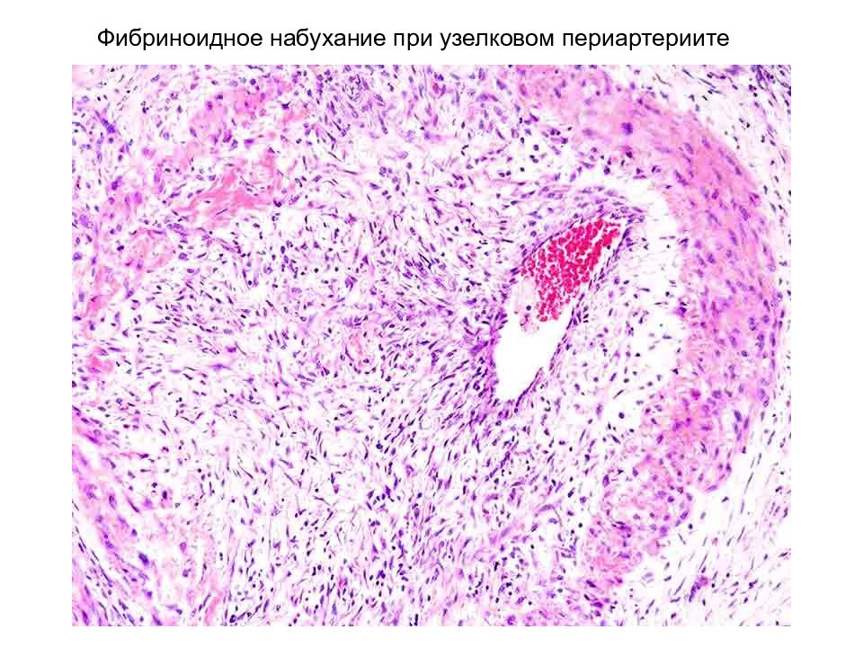 Фибриноидное набухание это. Фибриноидное набухание клапана сердца патологическая анатомия. Патологическая анатомия мукоидное набухание фибриноидное. Мезенхимальные дистрофии фибриноидное набухание. Узелковый периартериит почка микропрепарат.