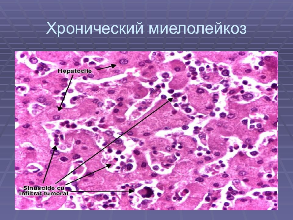 Гемобластозы патологическая анатомия презентация