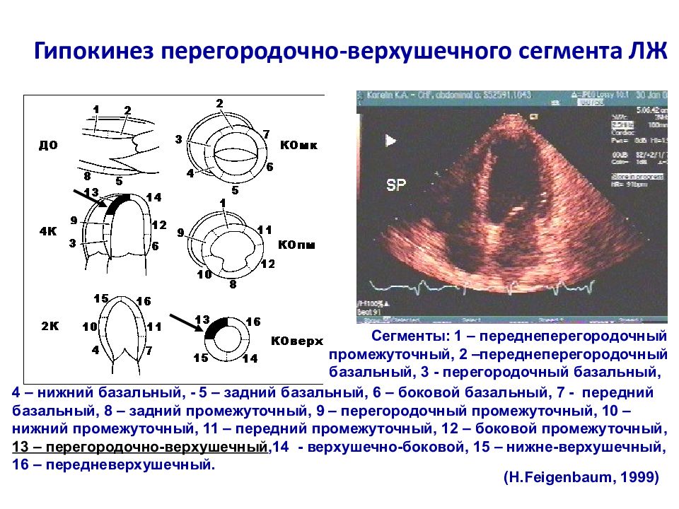 Эхо левого желудочка. Сегменты левого желудочка ЭХОКГ схема. Гипокинезия на ЭХОКГ. УЗИ сердца парастернальная позиция короткая ось. Гипокинез левого желудочка УЗИ.