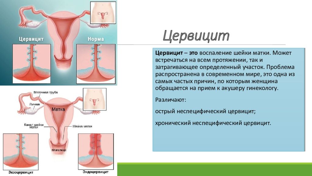 Цервицит схема лечения