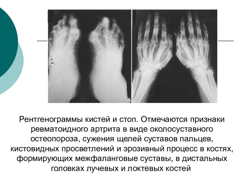 Остеопороз стопы. Ревматоидный артрит кисти рентген. Описание рентгена при ревматоидном артрите. Рентген ревматоидный артрит кистей стоп. Ревматоидный артрит кистей рентген заключение.