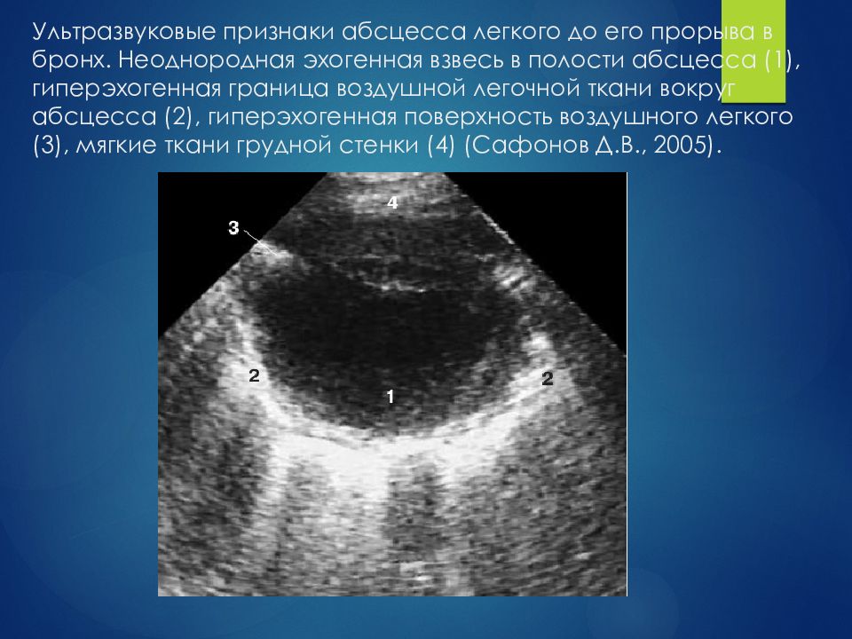 Абсцесс симптомы. Ультразвуковые признаки абсцесса. Гиперэхогенная взвесь. Симптомы абсцесса легкого до прорыва.