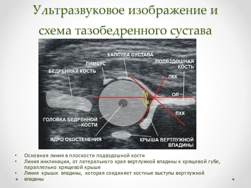 Ультразвуковое изображение и схема тазобедренного сустава