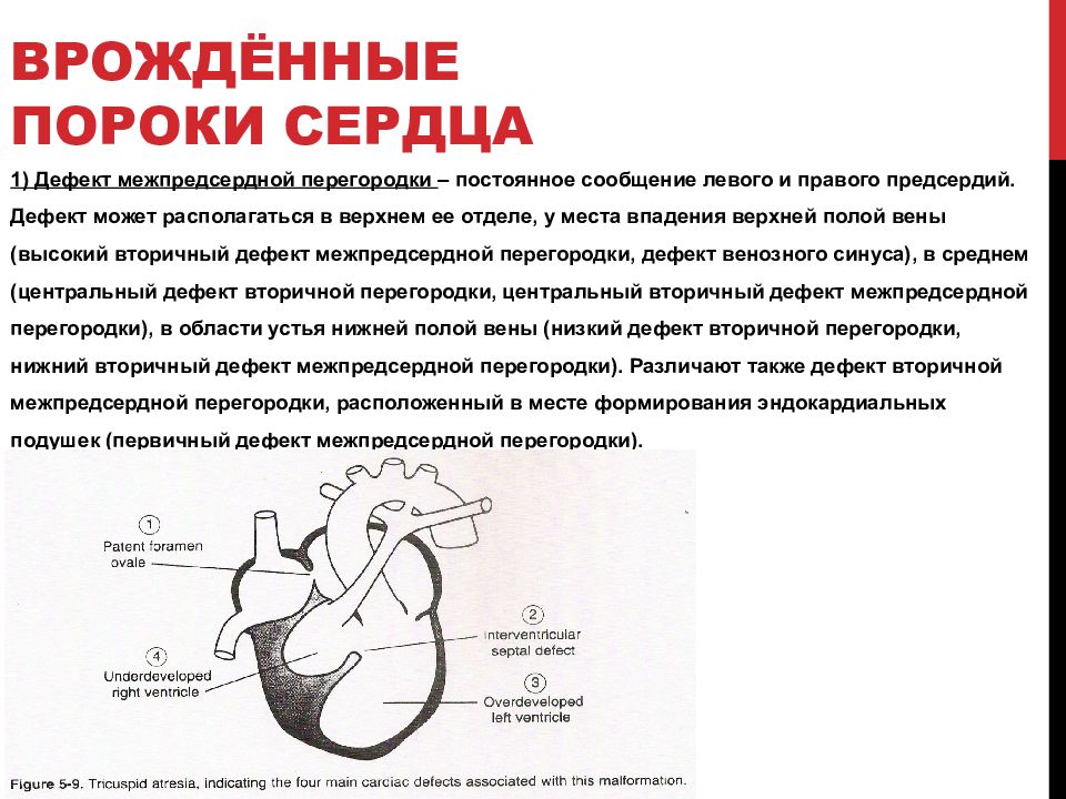 Аневризма межпредсердной перегородки. Врожденный порок сердца по мкб 10 у детей. Врожденный порок сердца код по мкб 10 у детей. Врождённый порок сердца мкб 10 у детей. ВПС ДМПП код по мкб 10 у детей.