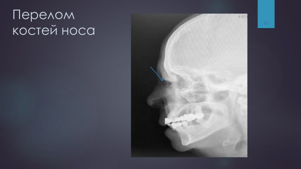 Перелом костей носа. Перелом носовая кость рентген. Кости носа рентгеноанатомия. Перелом носовой кости рентген. Оскольчатый перелом носа рентген.
