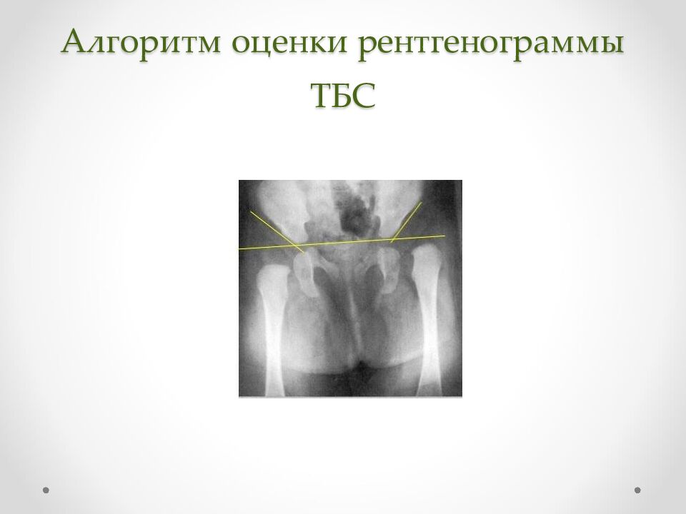 Алгоритм оценки рентгенограммы ТБС
