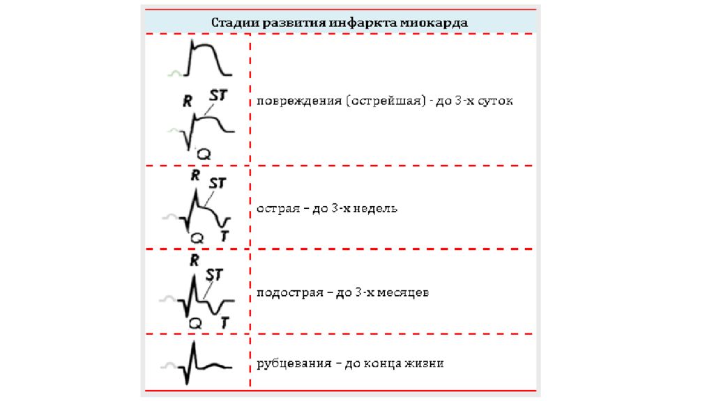 Инфаркт миокарда по времени