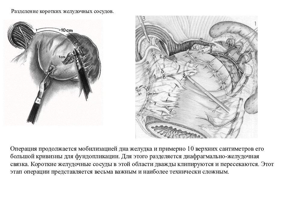 Диафрагмальные грыжи презентация хирургия