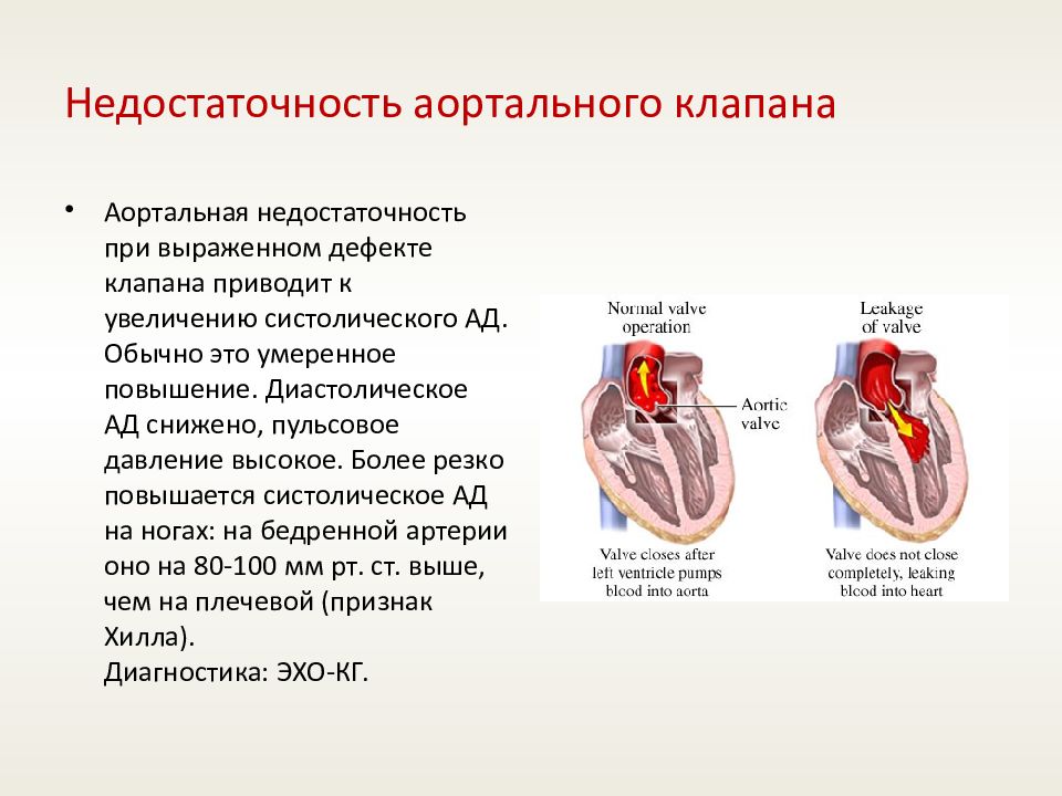 Сердечное понижено. Недостаточность клапана аорты гемодинамика. Артериальное давление при недостаточности аортального клапана. Синдром недостаточности аортального клапана. Недостаточность аортального клапана характеристика.