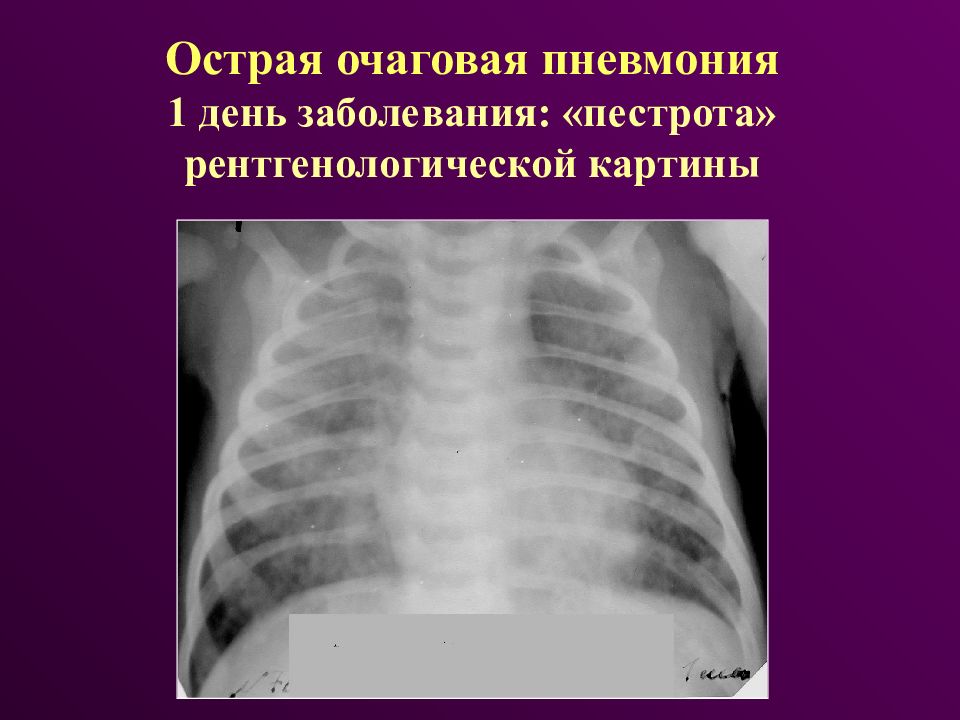 Острая пневмония у детей презентация