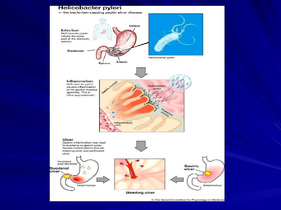 Гастрит хеликобактер. Язвенная болезнь хеликобактер пилори. Патогенез язвы желудка хеликобактер пилори. Язвенная болезнь желудка ассоциированная с Helicobacter pylori. Патогенез гастрита хеликобактер пилори.