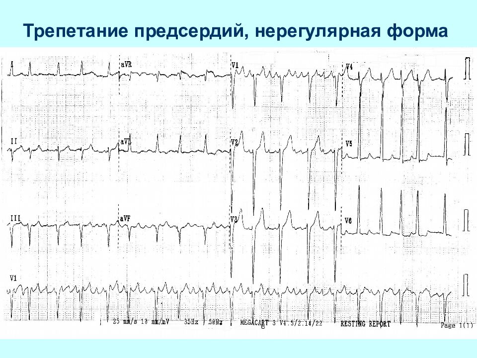 Экг при нарушениях ритма и проводимости презентация