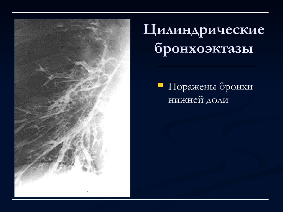 Цилиндрические бронхоэктазы. Цилиндрические бронхоэктазы рентген. Тракционные бронхоэктазы. Бронхоэктазы нижней доли