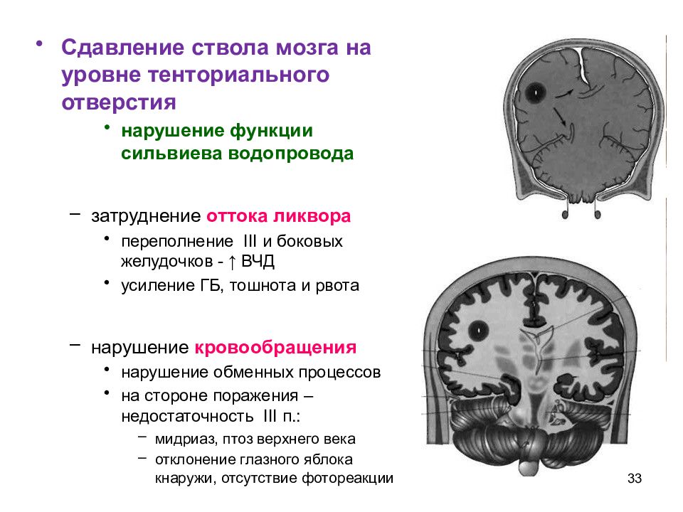 Опухоли цнс презентация